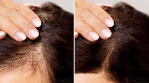 Top 5 Scientifically Proven Hair Loss Treatments - HairCareKey